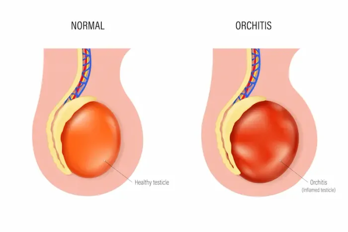 Orchitis: Overview of Causes and Treatment